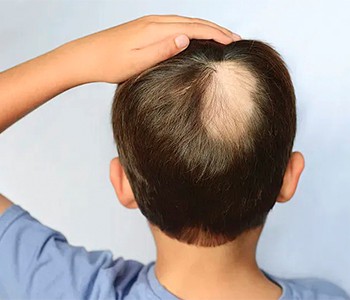 Hur hårt försökte de gamla att behandla håravfall